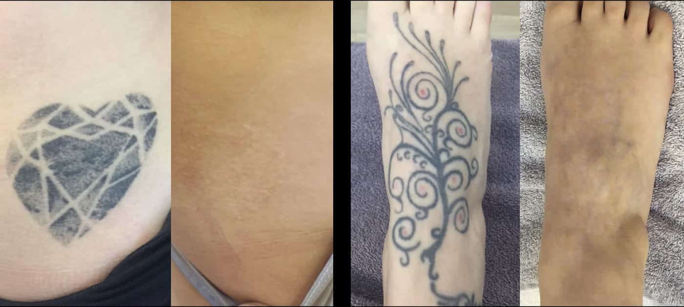 INKFREE, MD LASER CLINIC - 61 Photos & 39 Reviews - 11240 Fm 1960 Rd W 401,  Houston, Texas - Tattoo Removal - Phone Number - Yelp