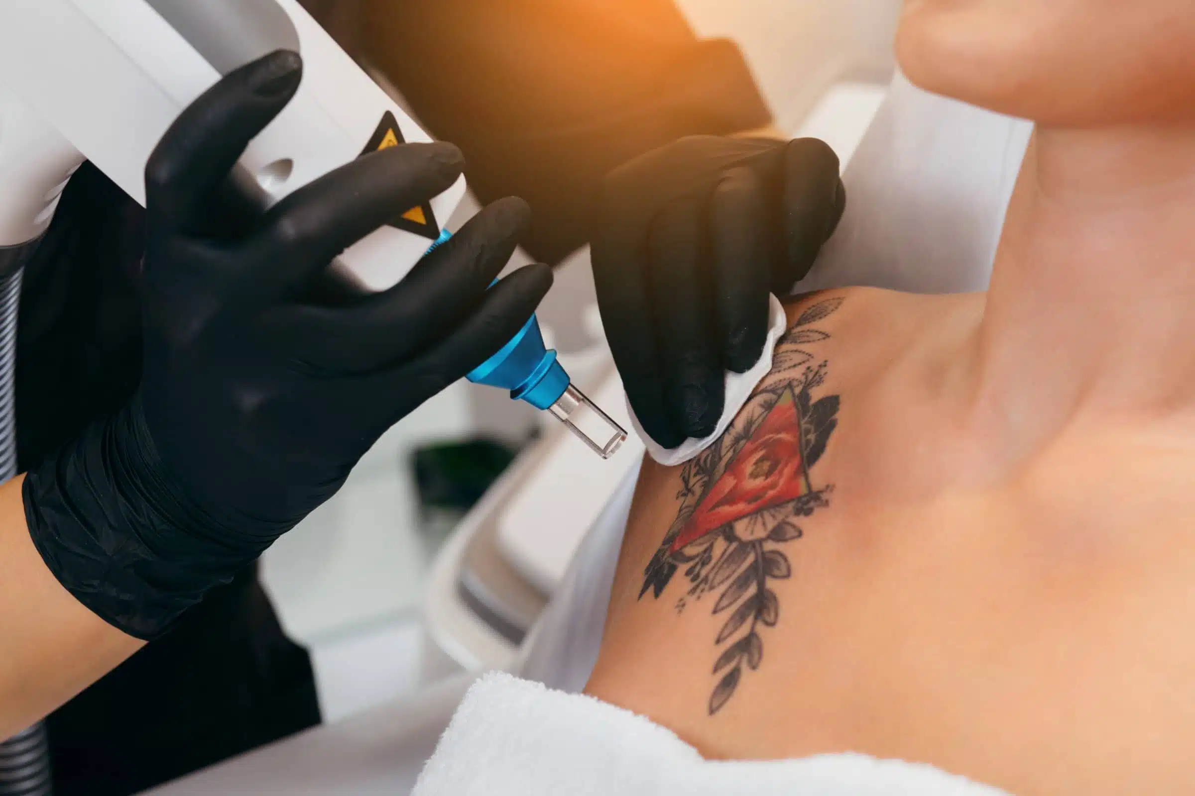 Combien de séances de détatouage sont nécessaires pour supprimer un tatouage ? | Clinique Bellefontaine | Lausanne