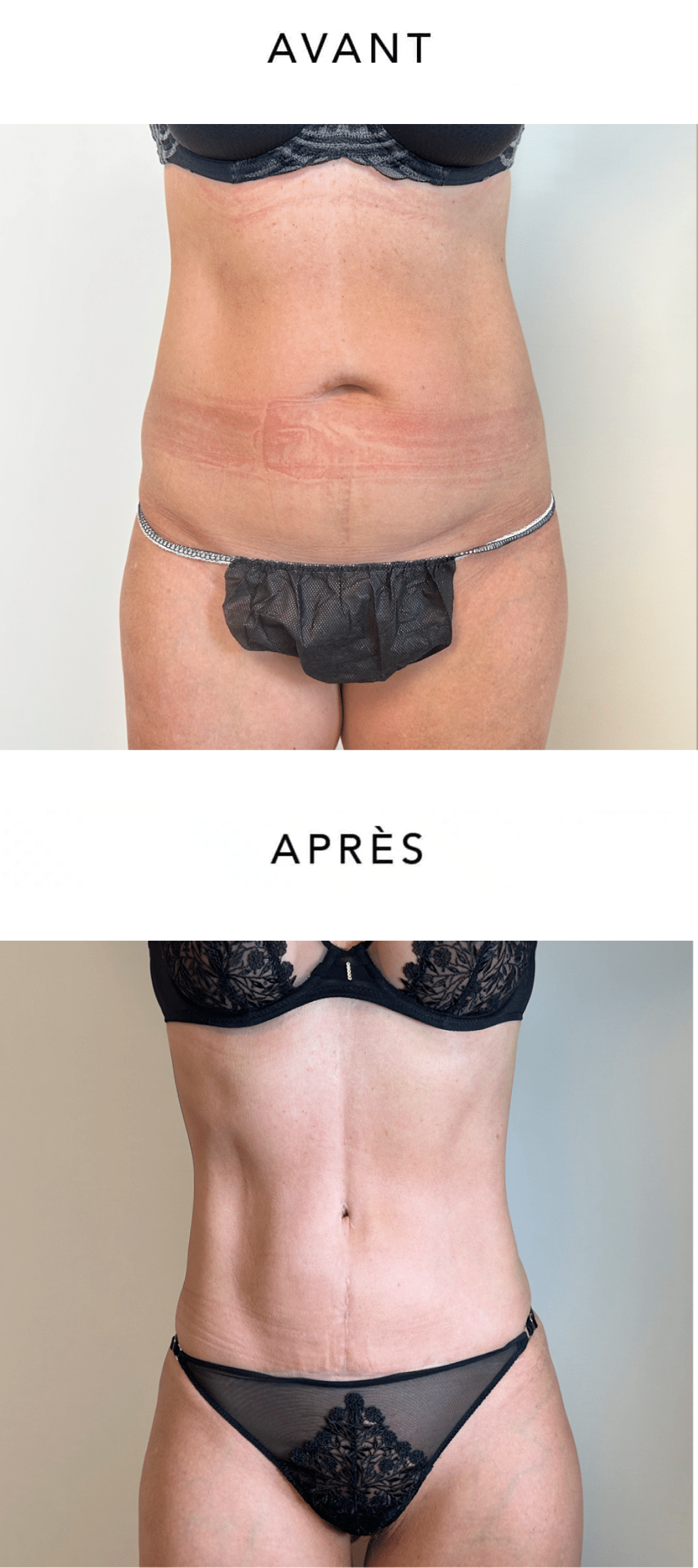 Ventre de femme de profil face avant/apres Lifting du ventre | Dr Favre Lausanne