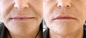 Bouche d une femme avant/apres injection acide hyaluronique pour le contour du visage | Dr Favre Lausanne | Dr Favre Lausanne