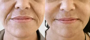 Visage de femme agee avant/apres injection acide hyaluronique pour le contour du visage | Dr Favre Lausanne | Dr Favre Lausanne