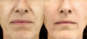 Visage de femme avant/apres injection acide hyaluronique pour le contour du visage | Dr Favre Lausanne | Dr Favre Lausanne