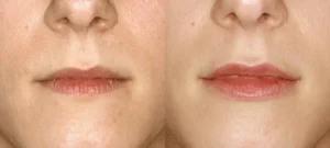 Photo de la bouche d une femme avant/apres Injections levres visages | Dr Favre Lausanne