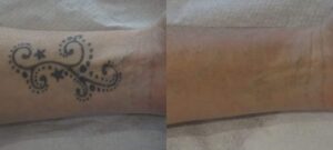 Photo de tatouage sur l avant bras avant/apres des seances de detatouage| Dr Favre Lausanne