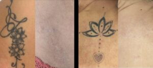 Deux photos montrant deux tatouage chacune avant/apres des seances detatouage | Dr Favre Lausanne